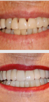 Dental crowns before and after.