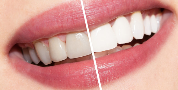 white teeth