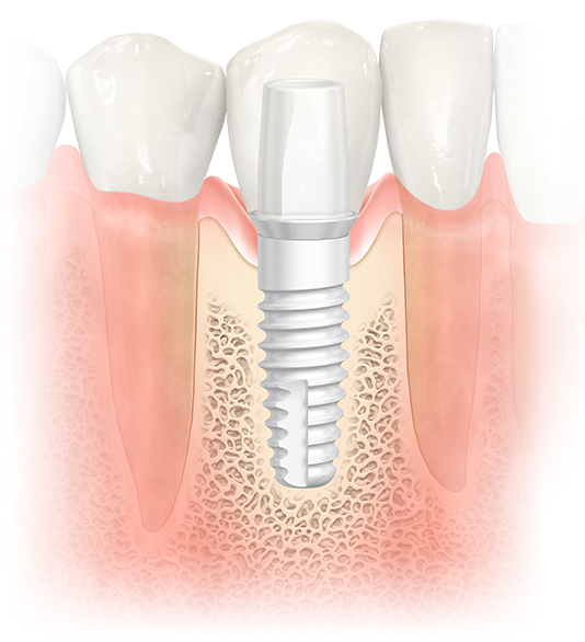 NobelPearl™ Dental Implants in NJ